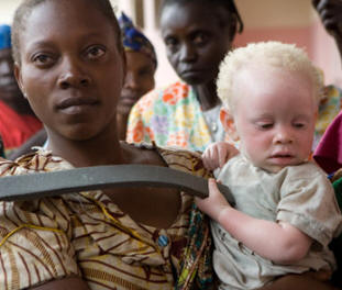 !!!!!AlbinoToddler1