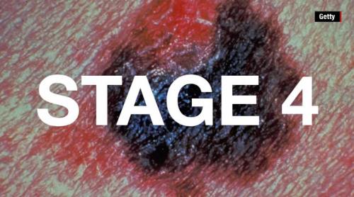 !!!!!MelanomaStage41
