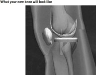 knee-replacement