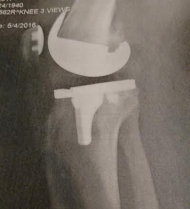 my-new-right-knee-in-place-x-ray