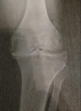my-old-right-knee-x-ray